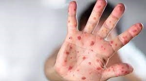 DSÖ'den Maymun Çiçeği İçin Küresel Acil Durum İlanı