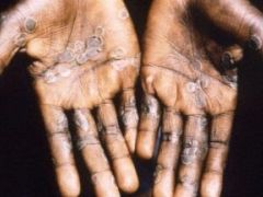 Maymun Çiçeği  Virüsü Türkiye’de