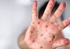 DSÖ’den Maymun Çiçeği İçin Küresel Acil Durum İlanı